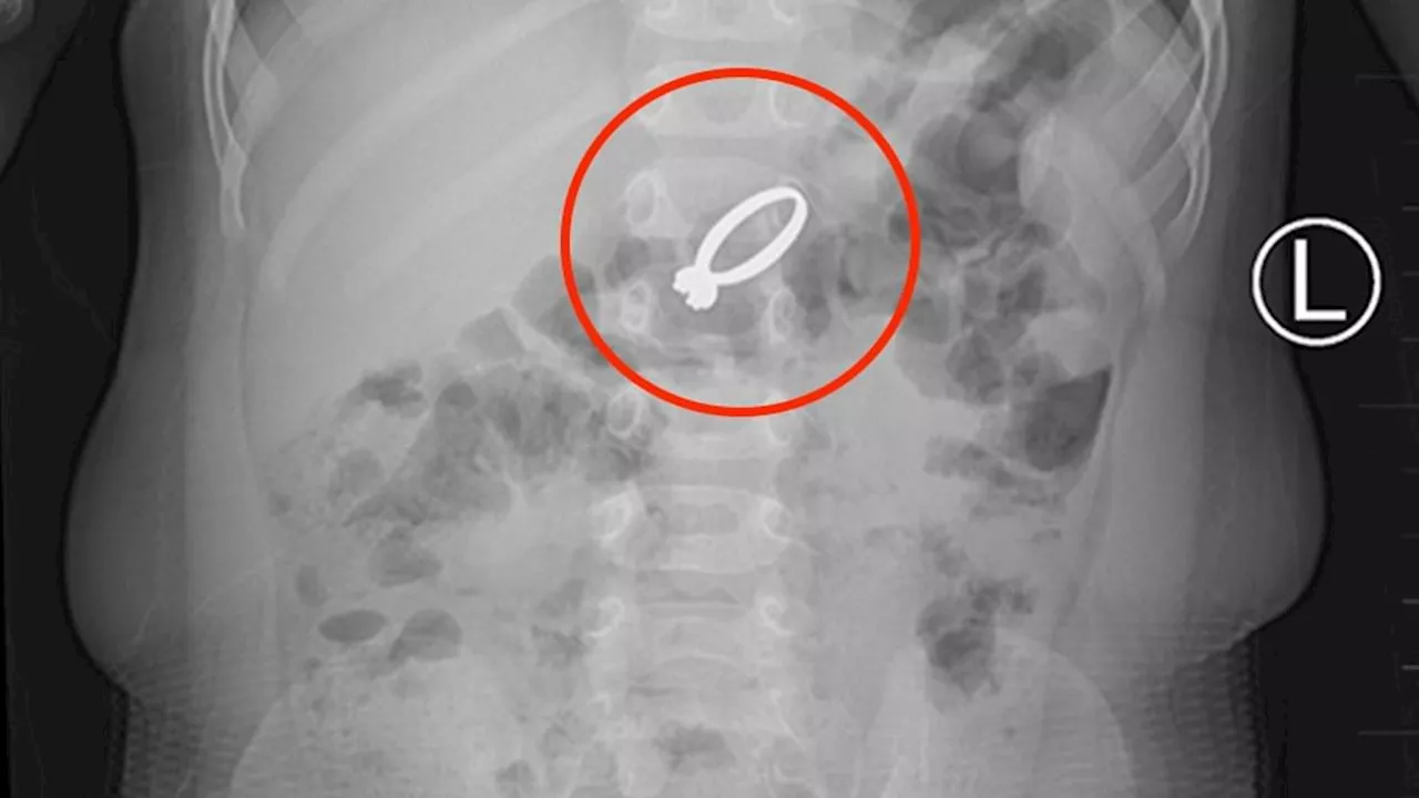 Toddler Swallows Mother's Diamond Ring, Requires Surgical Removal