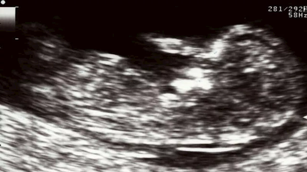 Nuchal Translucency Screens Detect Genetic Disorders at Lower Thresholds