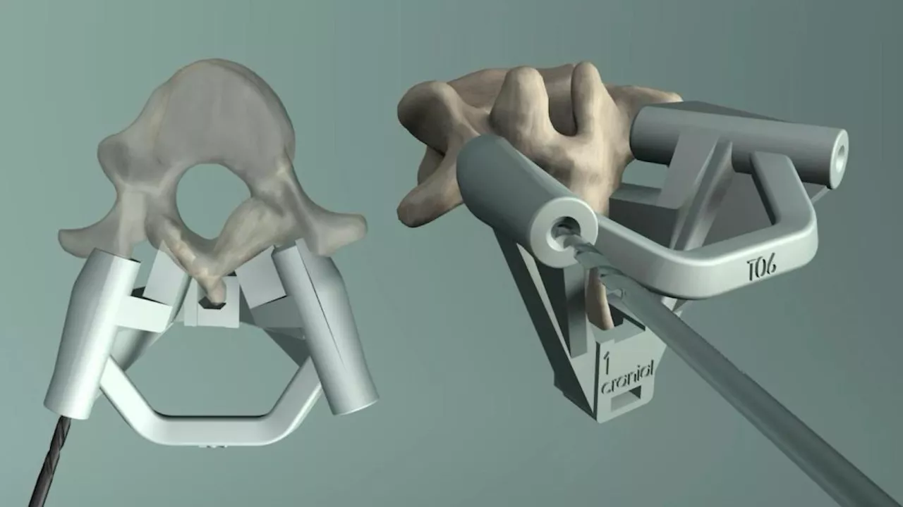 Stampa 3D per la colonna vertebrale. I «pezzi di ricambio» fungono da impalcatura per la ricostruzione ossea