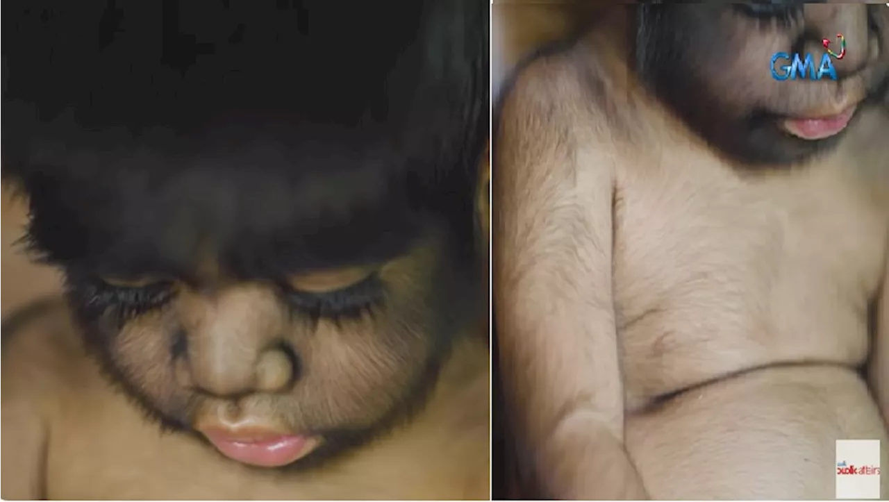 Child with Abnormal Hair and Fur: Is it a Result of Maternal Cravings?