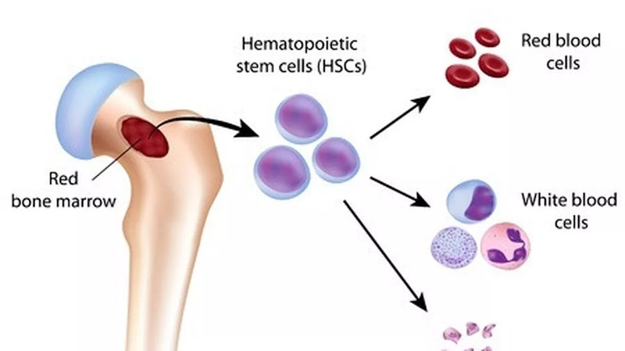 Babe Cabita Meninggal karena Anemia Aplastik, Apa Itu? Berikut Penyebab dan Gejalanya