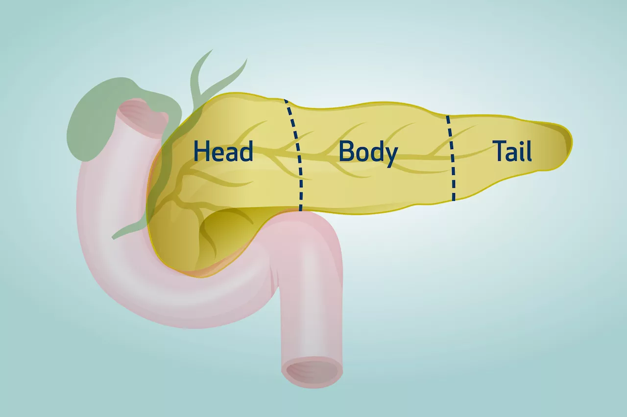 Researchers find difference in pancreatic cancer cells, offering new hope for immunotherapy effectiveness