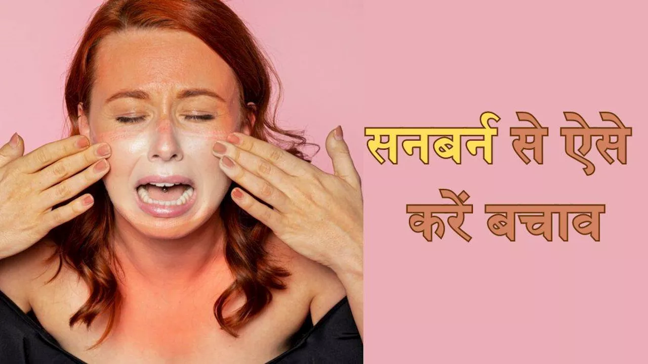 Sunburn की वजह बन सकती है झुलझाने वाली धूप, इन टिप्स की मदद से गर्मियों में रखें अपनी त्वचा का खास ख्याल