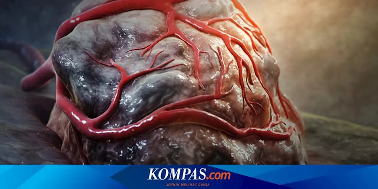 Pria di India Ini Memiliki Tumor Seberat 17,5 Kg, Awalnya Mengeluh Sakit Perut