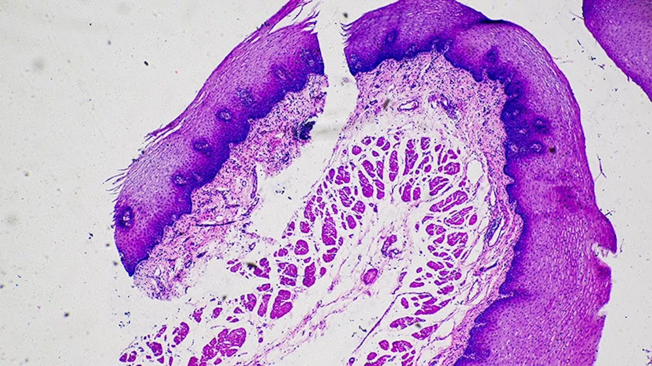 Immunosuppression Independent Risk Factor for Poor Cutaneous Squamous Cell Carcinoma Outcomes