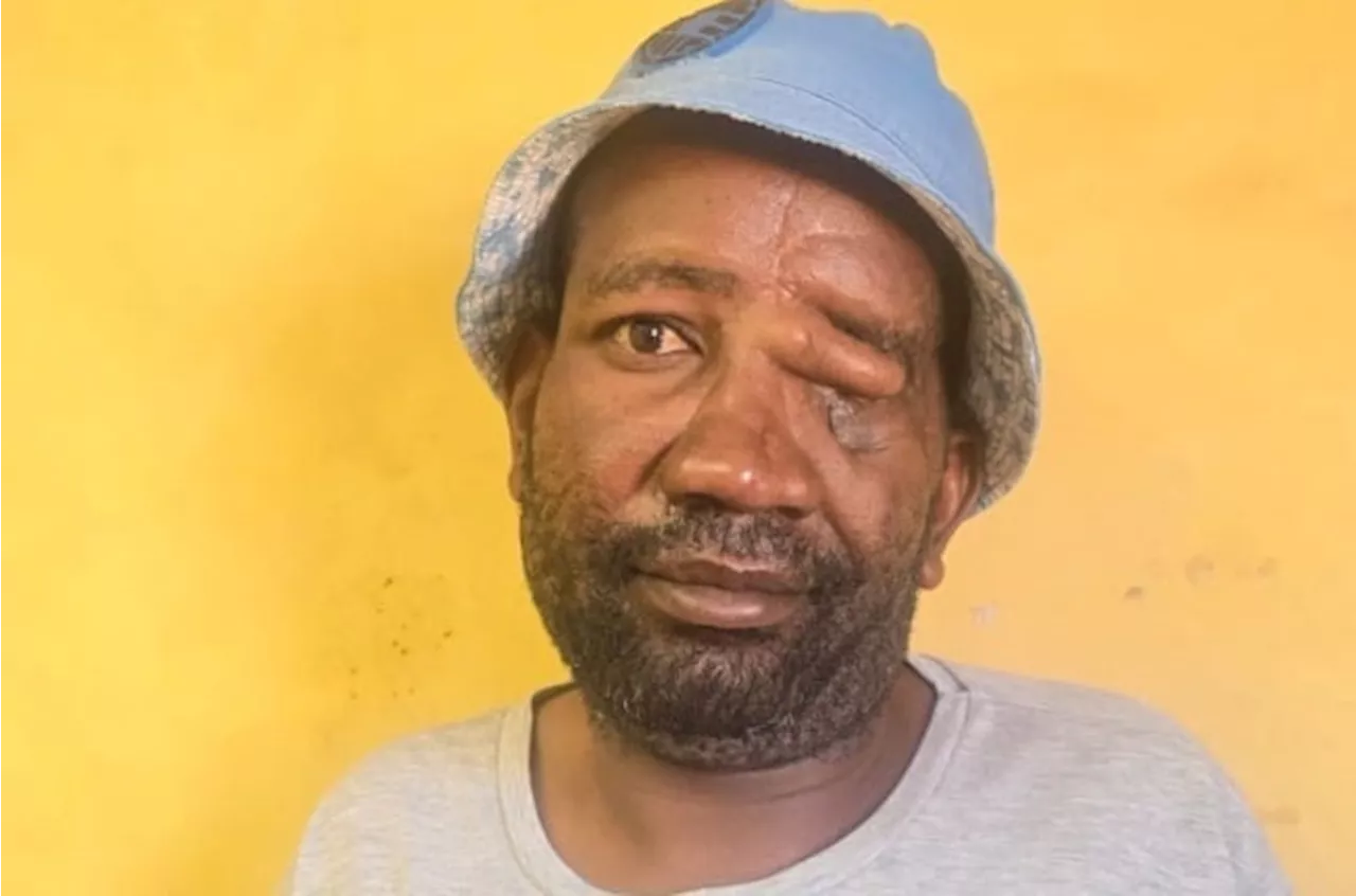 Limpopo man on horror hyena attack: ‘ I realised something was eating me right there and then’