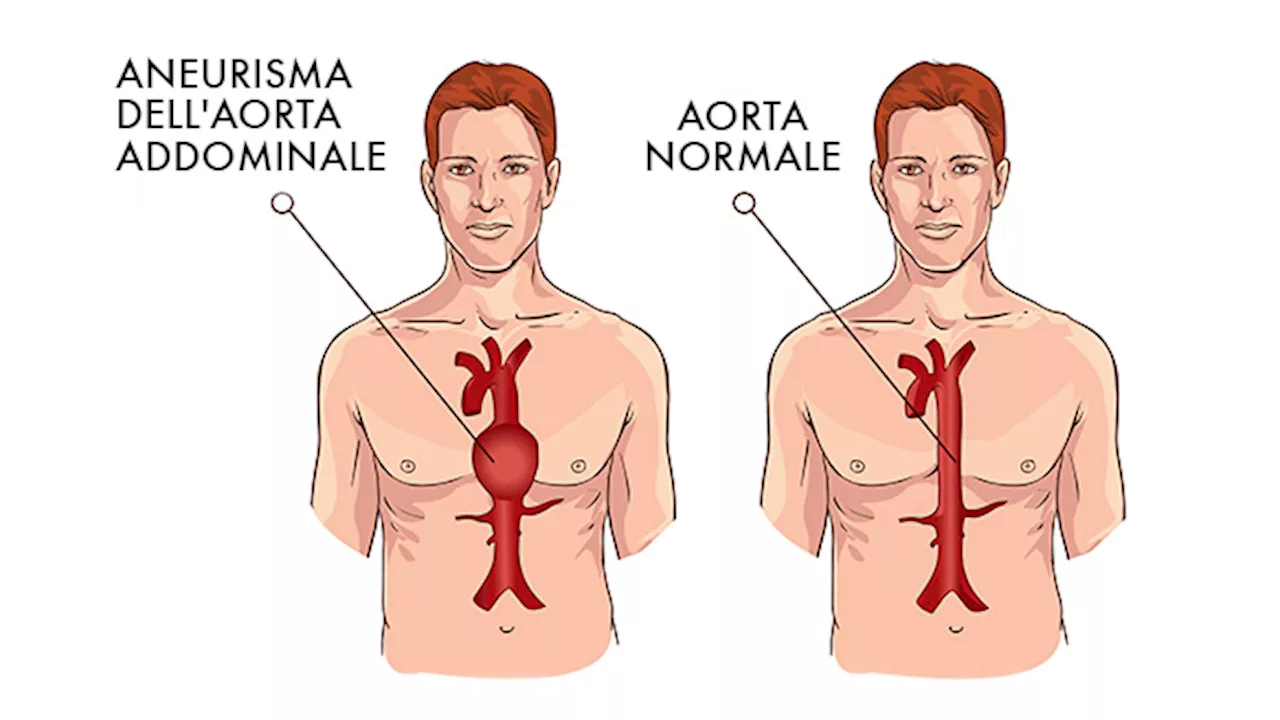 Aneurisma dell’aorta addominale: nuova importante scoperta