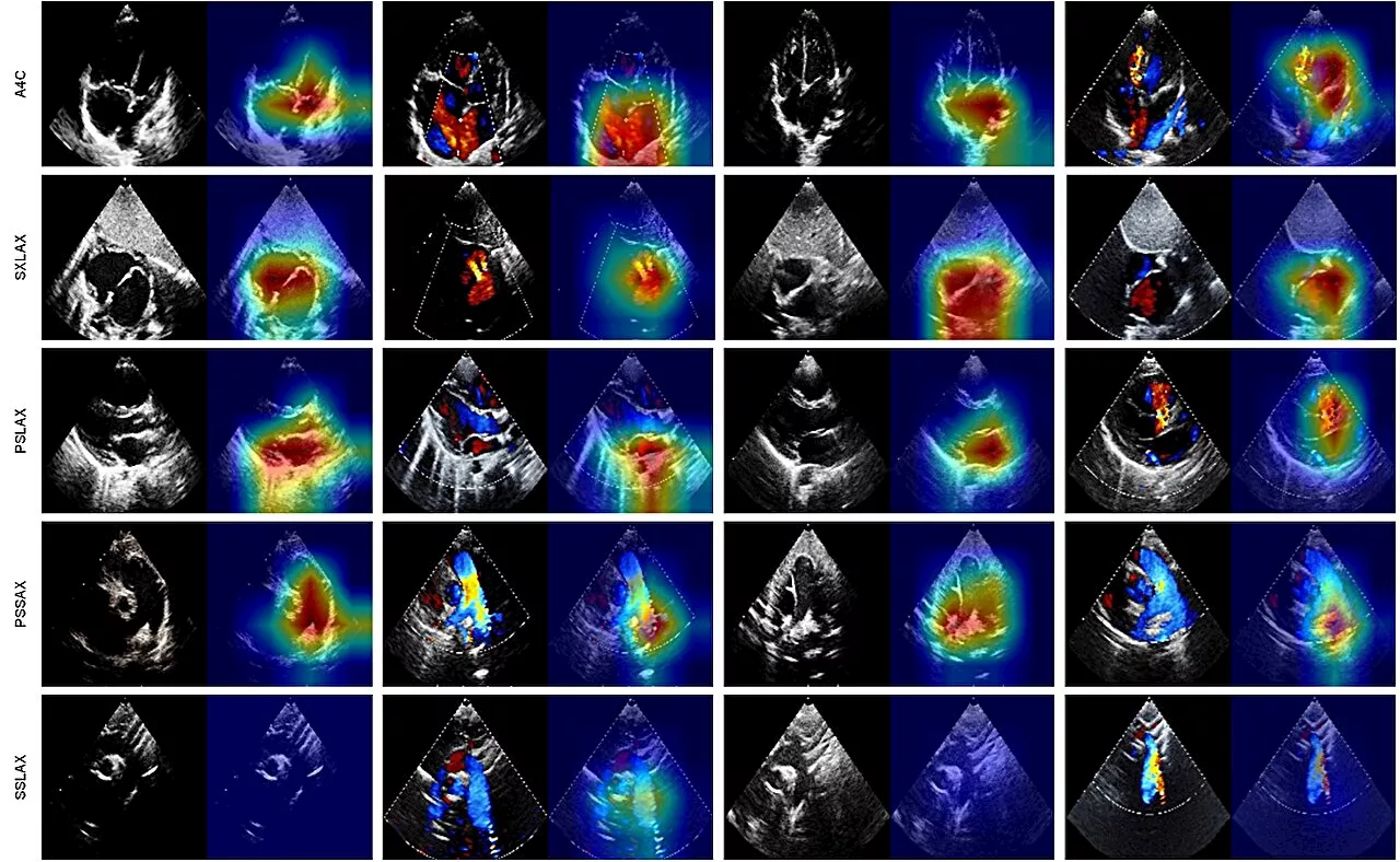 An auxiliary CHD diagnostic system based on multi-view and multi-modal transthoracic echocardiograms