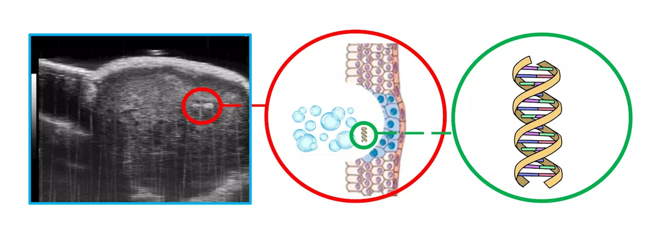 Intense ultrasound extracts genetic info for less invasive cancer biopsies