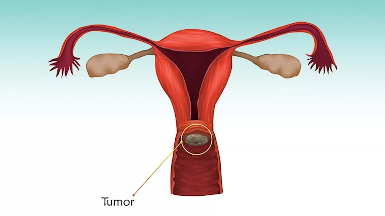 Hypofractionated Radiotherapy Limits Toxic Effects in Cervical Cancer