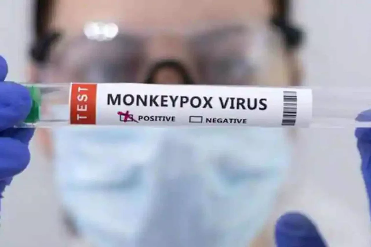 New case of monkeypox confirmed at Ahmed Kathrada Hospital