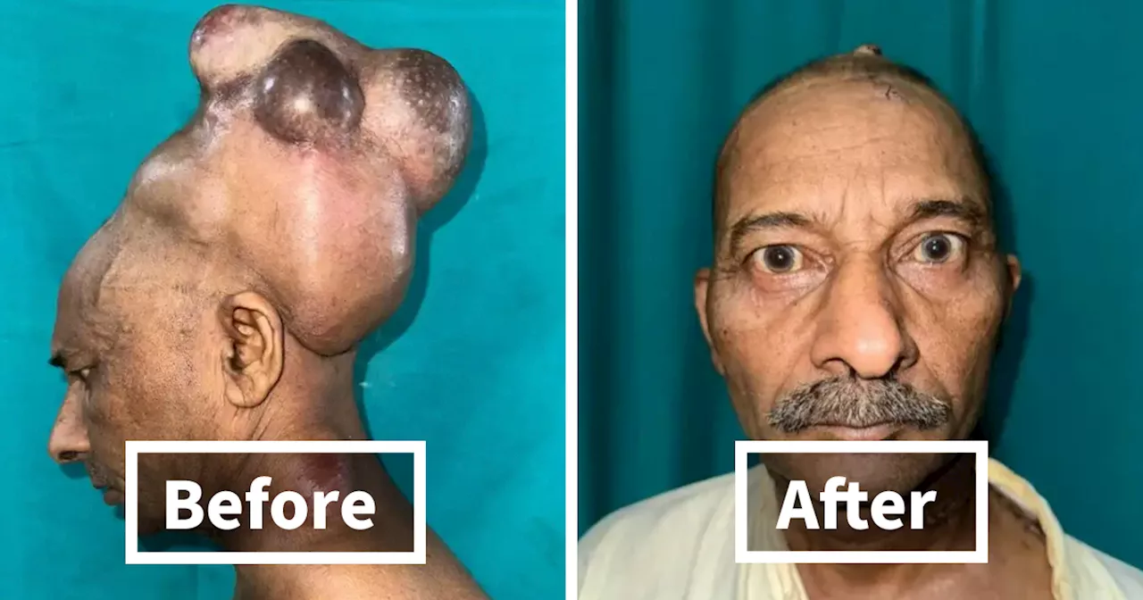 10-Hour Operation To Remove 15-Lb Tumor From Man’s Head Deemed “Medical Miracle”
