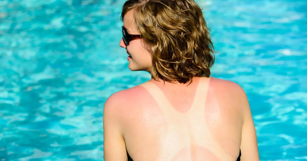 Ein Drittel der Bevölkerung hatte heuer schon einen Sonnenbrand