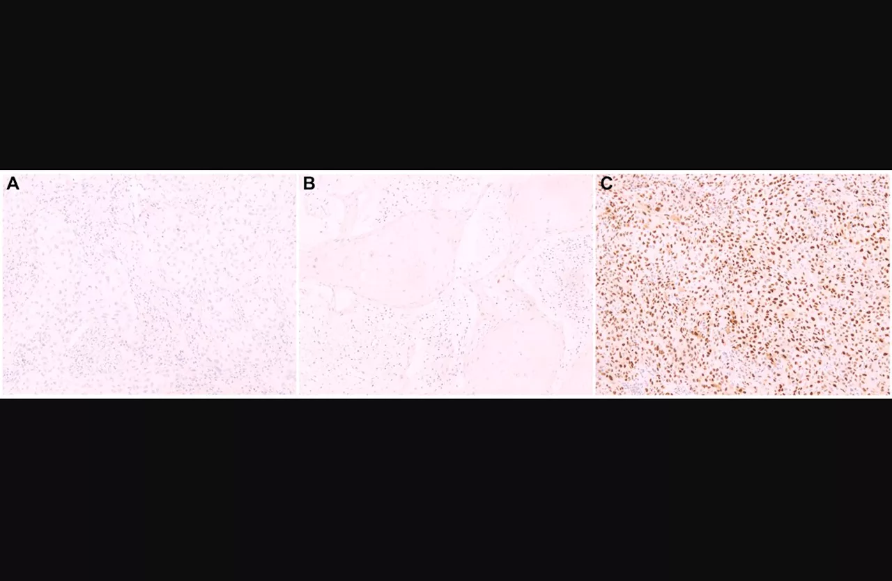 Cyclin D1 expression may be a biomarker for penile cancer