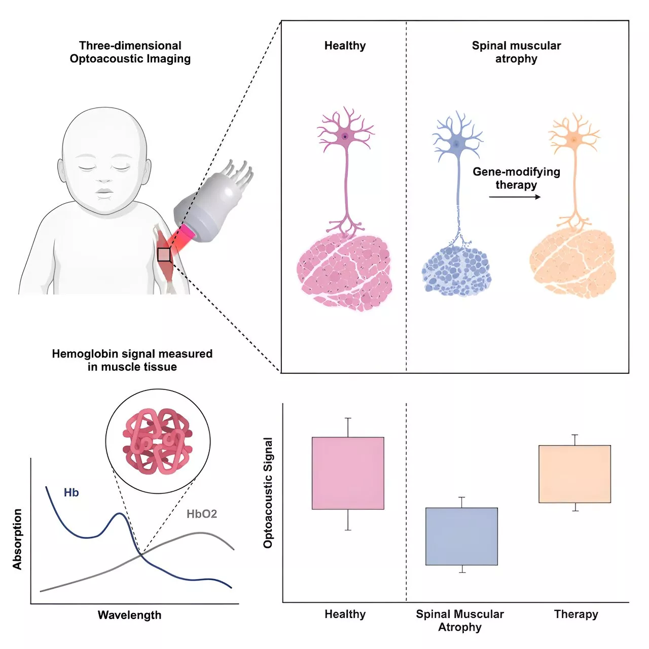 Researchers develop method to monitor patients with spinal muscular atrophy using sound waves