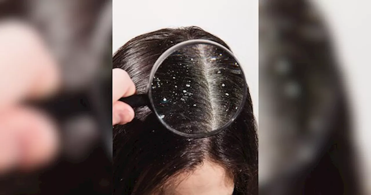 Dandruff को जड़ से साफ कर देंगे ये 9 घरेलू उपाय