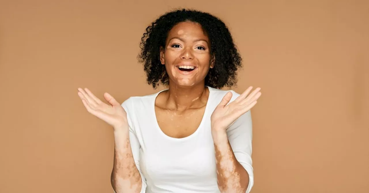 Vitiligo: Neue Therapien machen Weißfleckenkrankheit besser behandelbar