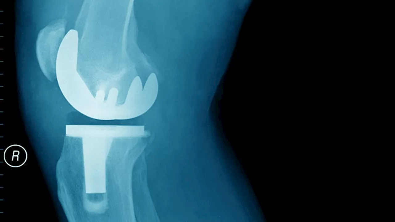 Arthroscopy Doesn't Delay Total Knee Replacement in Knee Osteoarthritis