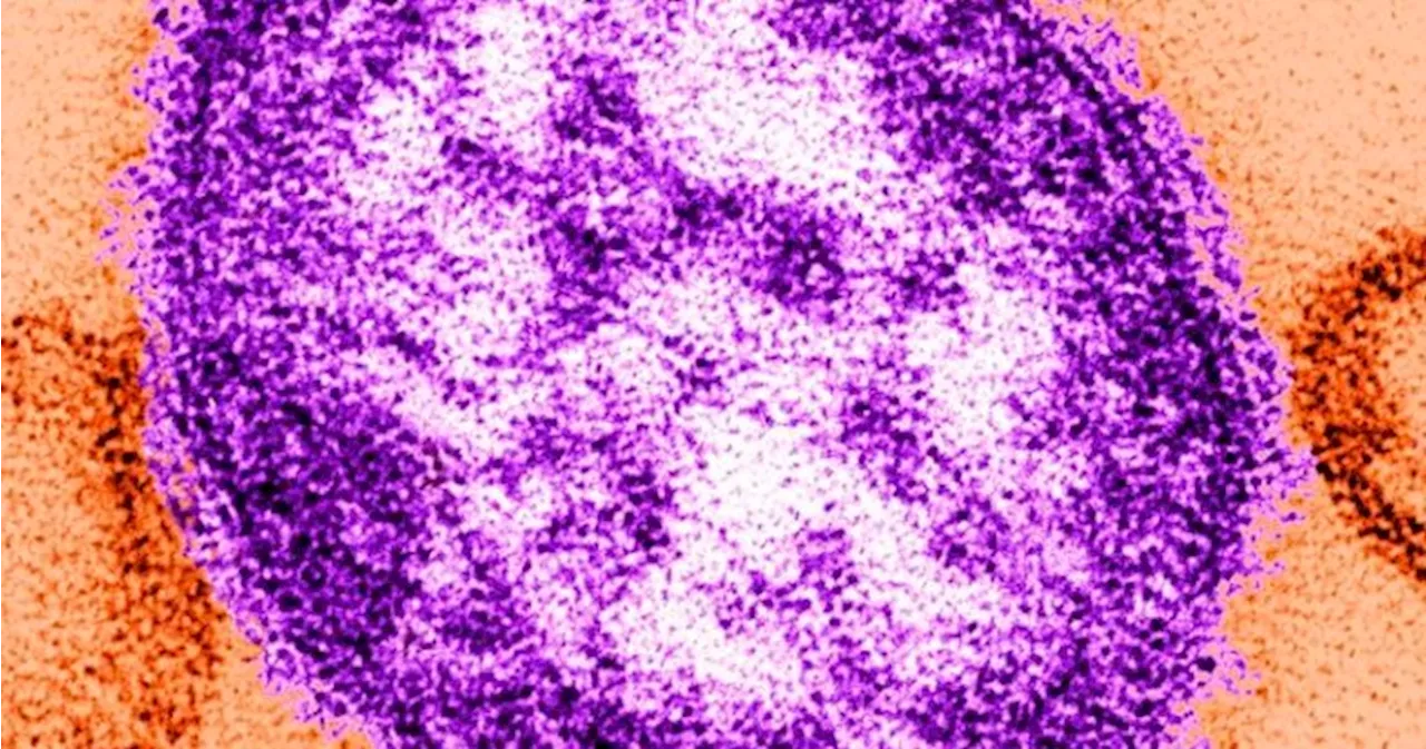 Child under 5 dies after being hospitalized for measles: Public Health Ontario