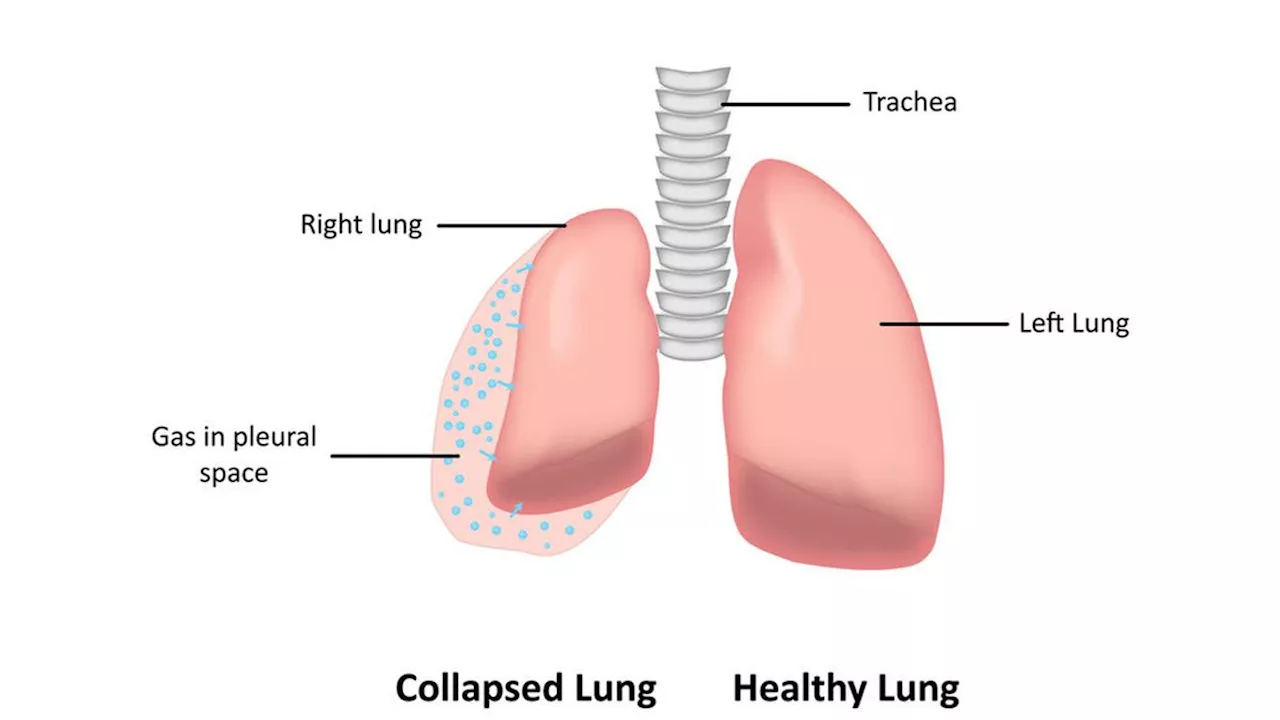 Apa itu Pneumothorax? Gangguan Paru-Paru yang Diidap Winter aespa