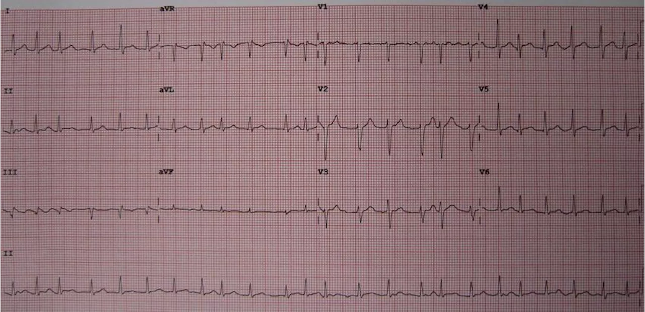 Study reports 'excellent' outcomes for patients receiving optimized treatment for atrial fibrillation