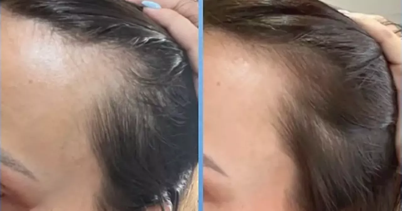 Shoppers love new hair growth serum that gives ‘double the amount of hair’