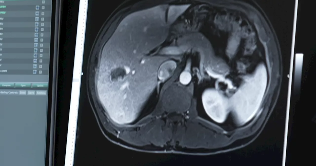 New procedure allows doctors to treat liver tumors using sound waves