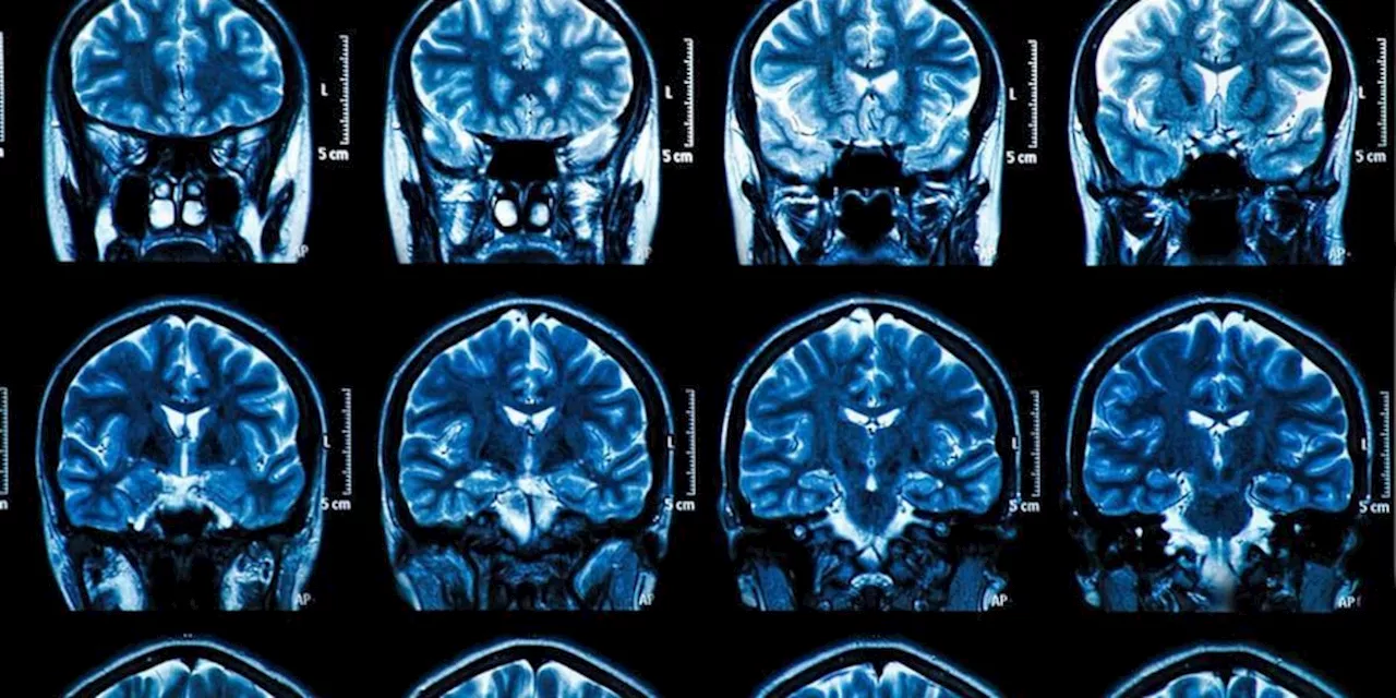 Alzheimer: Müller litt wie 1,6 Mio Deutsche an Demenz – wie Sie vorbeugen können