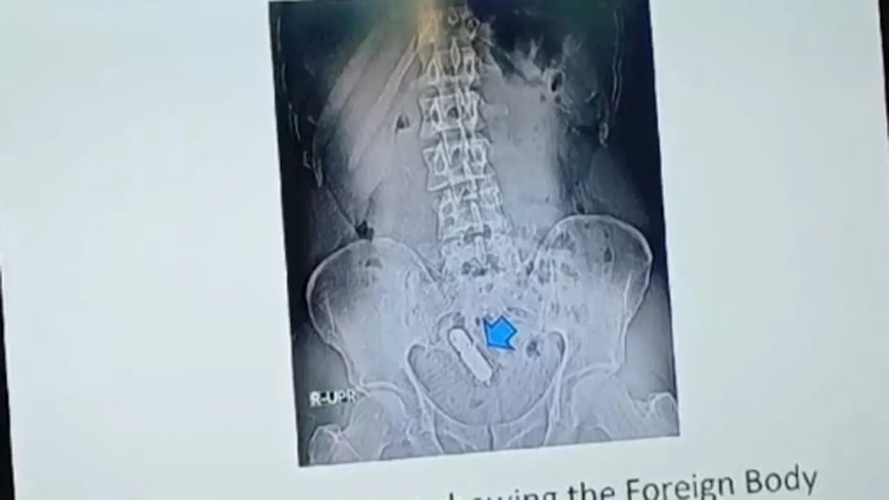 UP: शख्स के पेट में हो रहा था दर्द, X-ray कराया तो निकला सेक्स टॉय