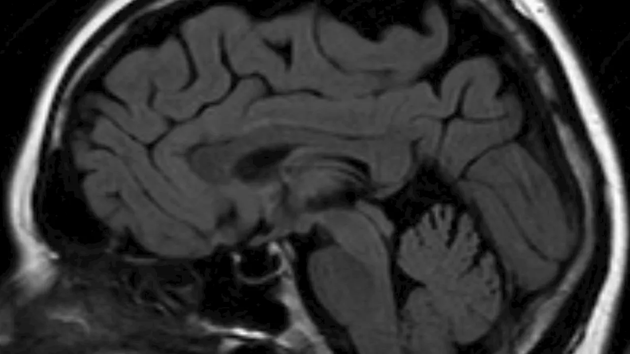 Mengenal Empty Sella Syndrome, Penyakit Langka yang Dapat Pengaruhi Kesuburan