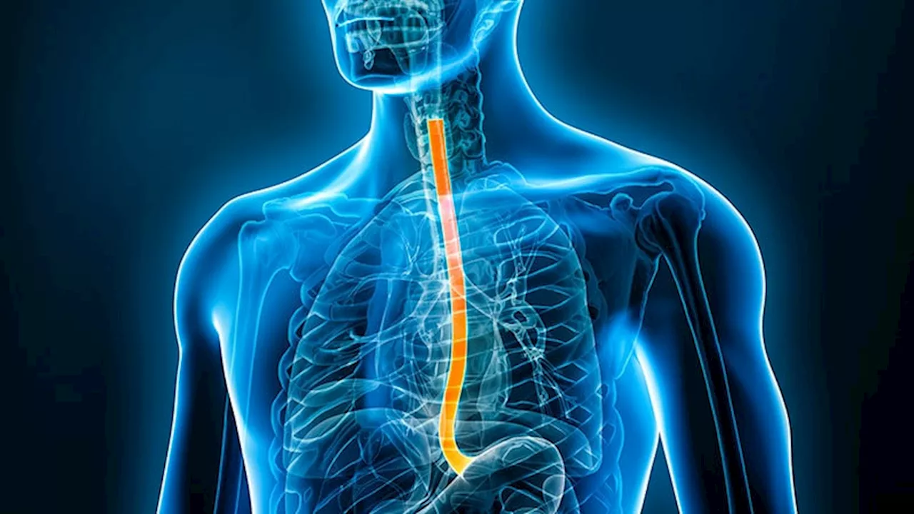 Barrett's Esophagus: Patient-Centered Treatment Approach Is Key