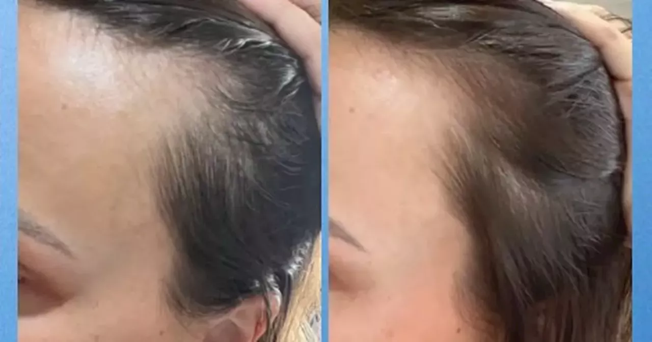 Shopper say hair growth serum gives 'double the amount of hair' in 5 weeks