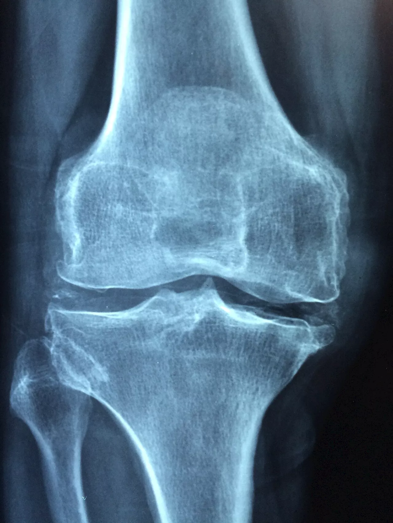 Naturally-occurring peptide shows promise as new therapeutic in bone repair