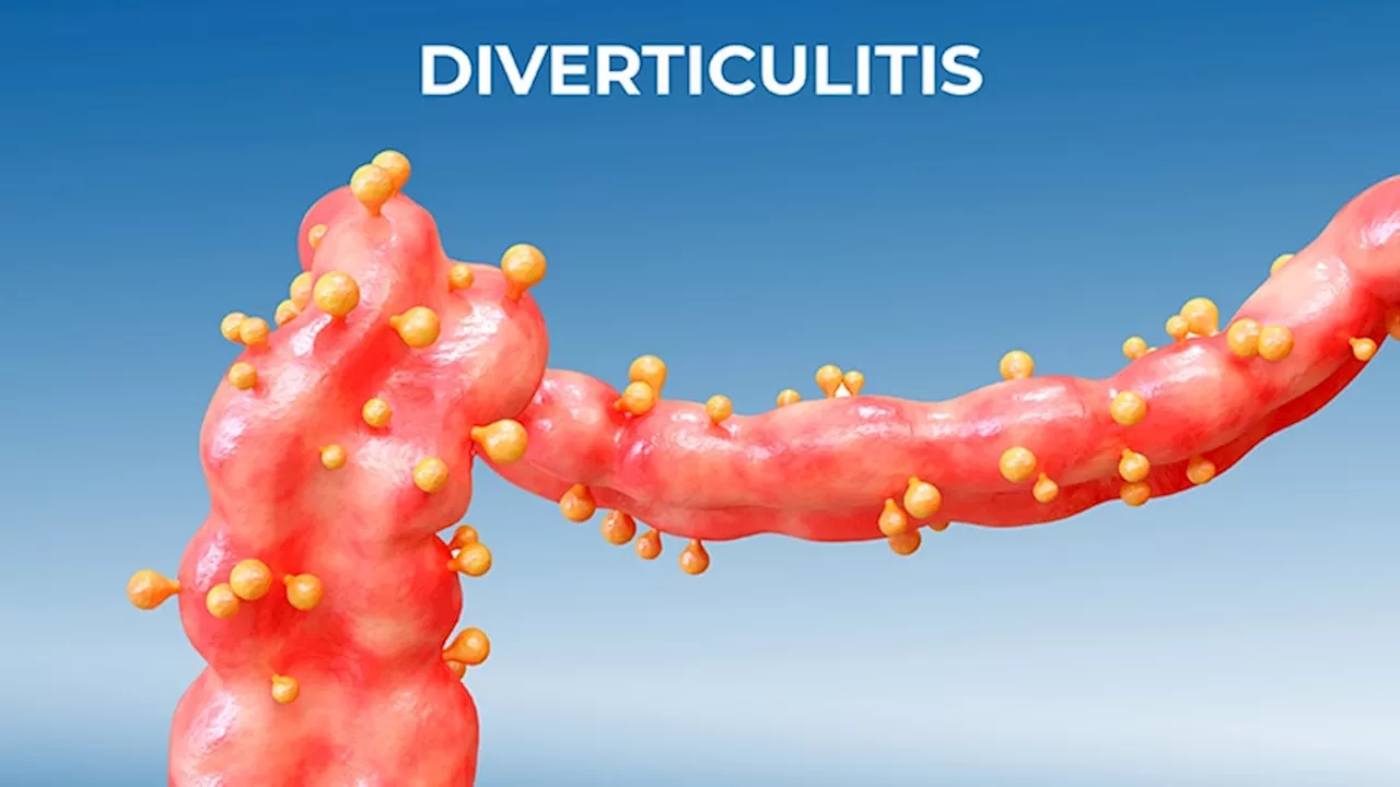 CRC Risk Appears Low in Most Patients With Uncomplicated Diverticulitis