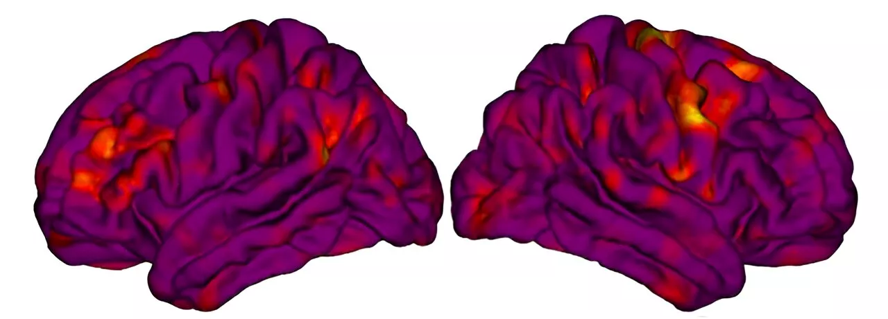 Researchers find key differences in brain development between autistic boys and girls