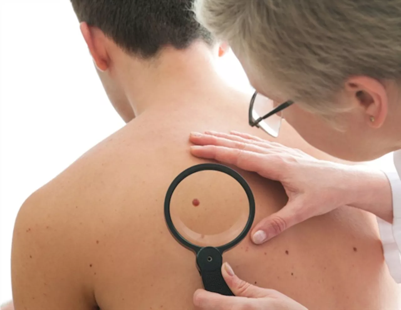 Cleveland Clinic study reveals significant genetic predisposition in melanoma patients