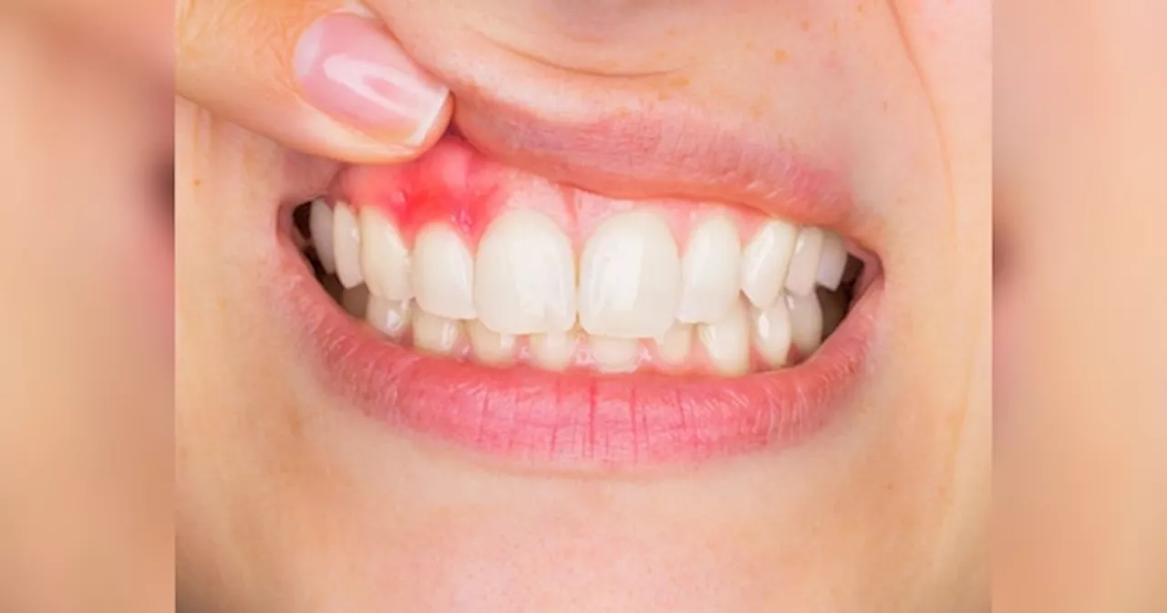 Gingivitis: मसूड़ों की सूजन और खून आने की समस्या से जल्दी छुटकारा दिलाएंगे ये घरेलू नुस्खे