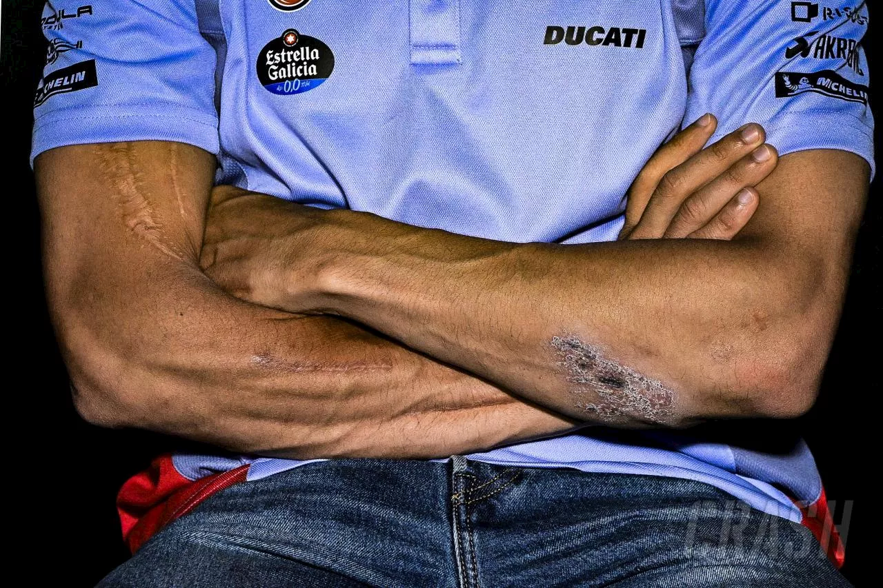 Brutal cuts and scars on Marc Marquez's arms tell their own story