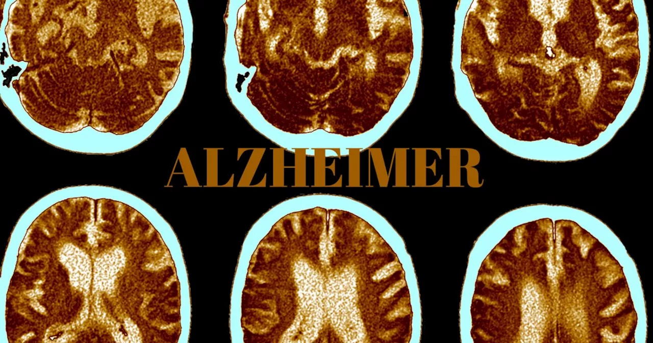 Voici pourquoi certains cerveaux 'résisteraient' mieux face à la maladie d’Alzheimer