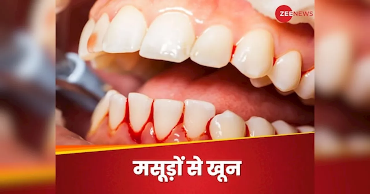 Gum Bleeding: मसूड़ों से आने लगा खून तो जरा भी घबराएं नहीं, जरूर करें ये 4 उपाय