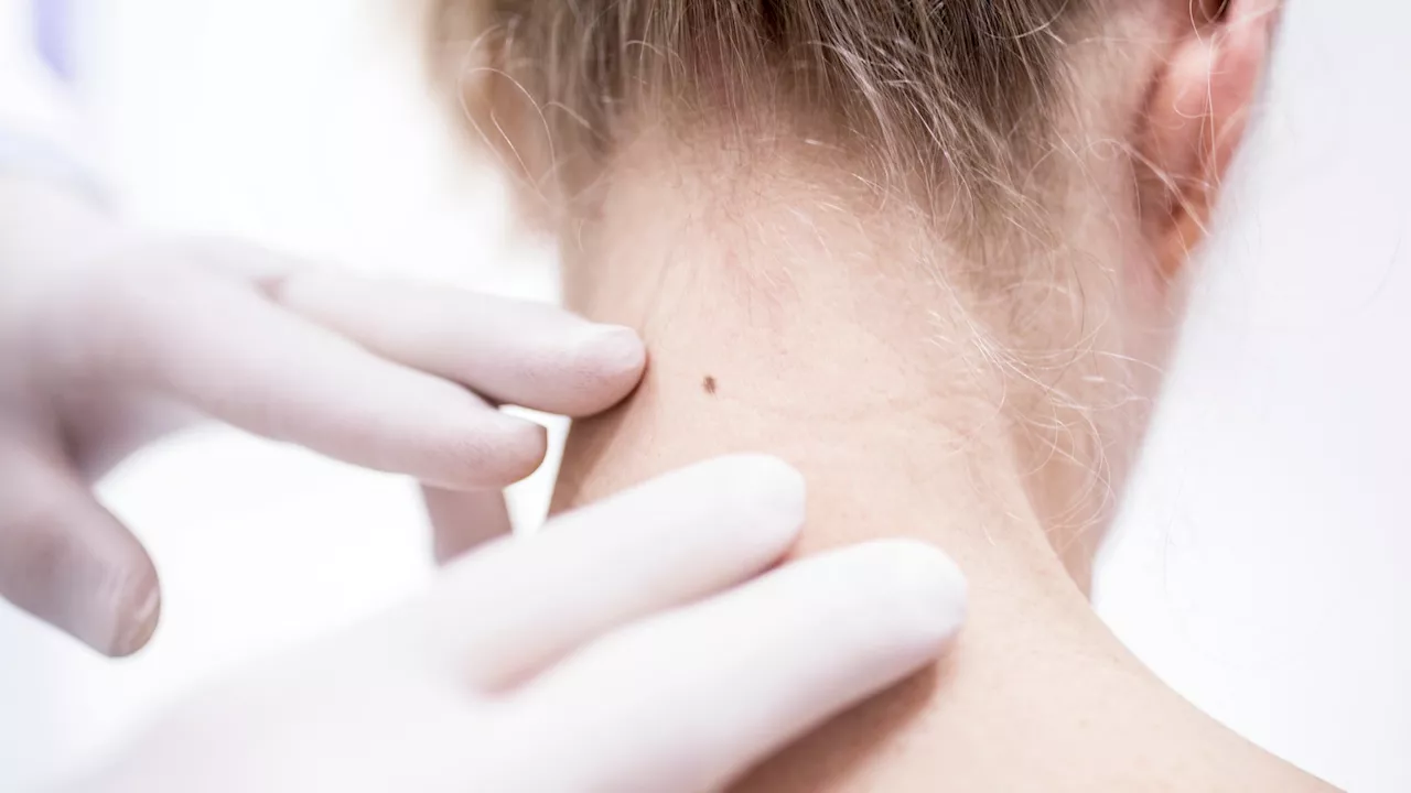 Skin cancer rates to reach record high – increasing by almost a third over past decade...