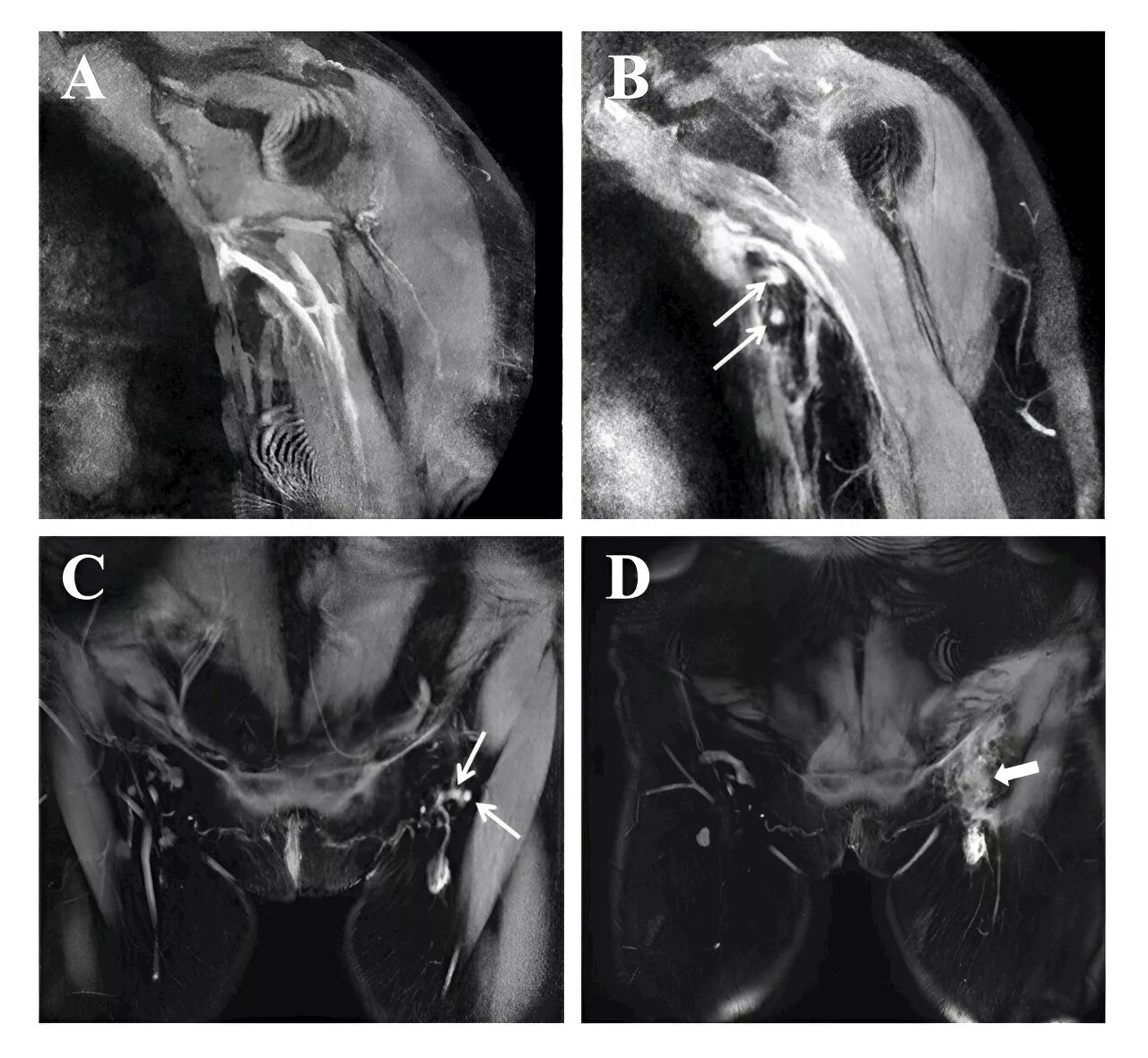 Effective lymph node transfer eases arm swelling in breast cancer patients