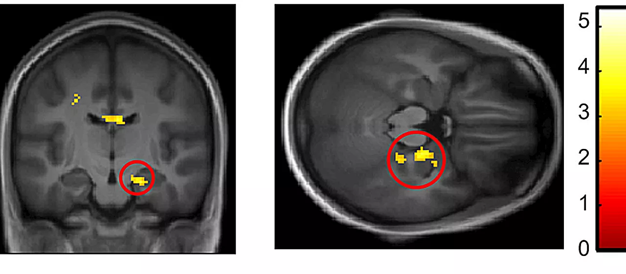 Investigating hyperactivation of memory circuits and Alzheimer's disease risk