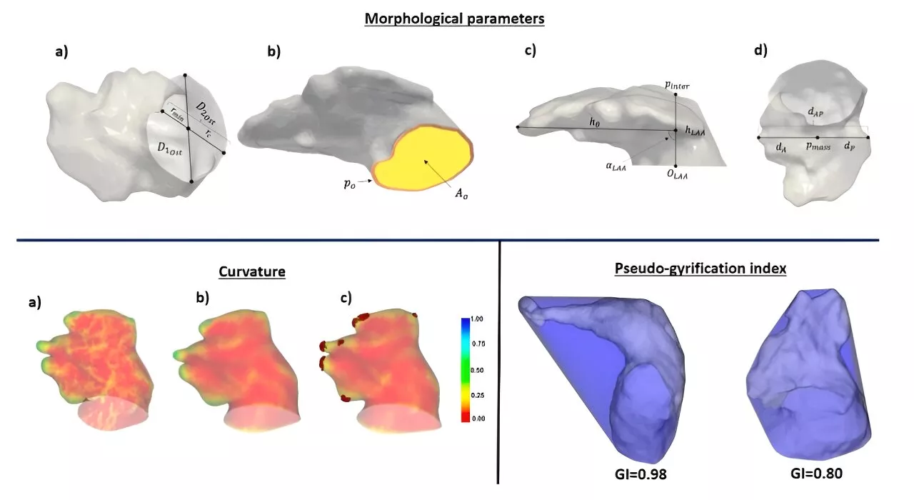 Study finds blood clot risk is influenced by angle at which pulmonary veins reach the heart