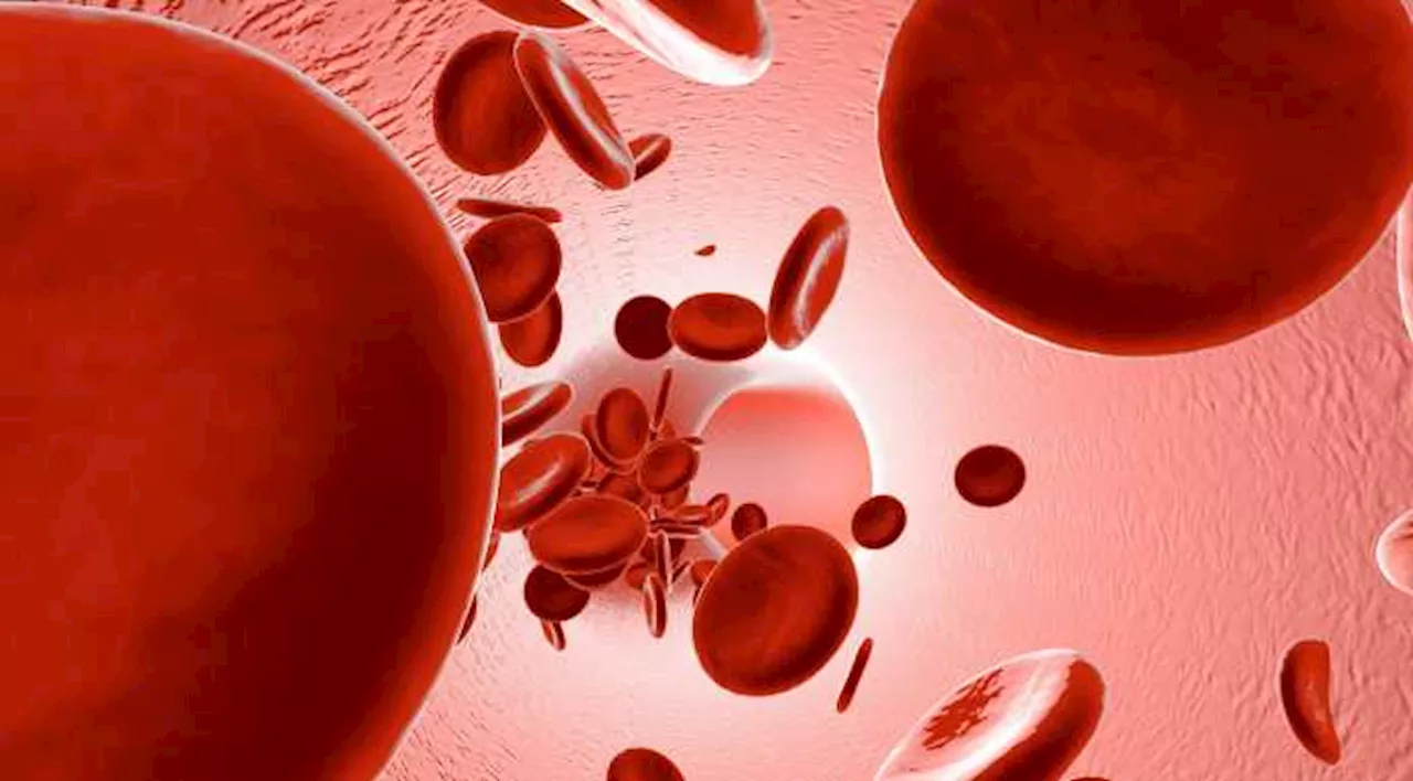 Nuova terapia contro la leucemia con cambio totale del sangue