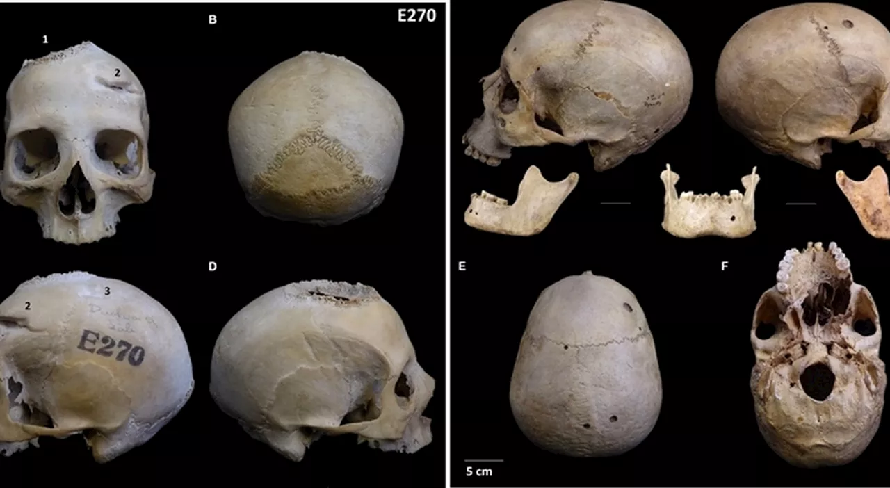 Egitto, segni di chirurgia anticancro su un cranio di 4.000 anni fa