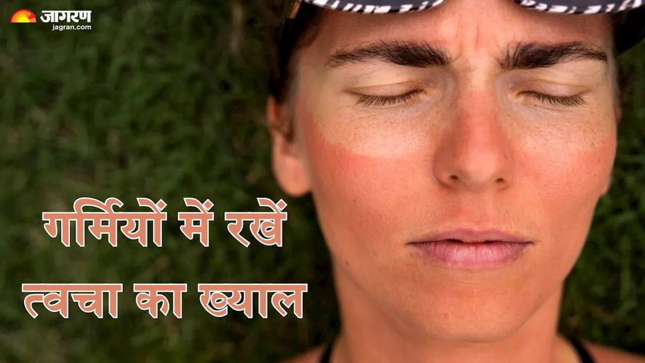 क्या है Sunburn और Sun Poisoning जो गर्मियों में पहुंचा सकते हैं त्वचा को गंभीर नुकसान, जानें कैसे करें बचाव