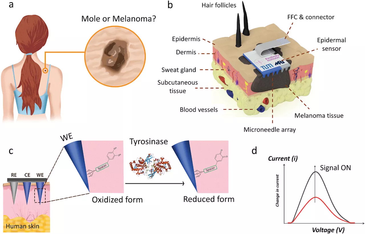 Researchers develop microneedle patch that can detect skin cancer early