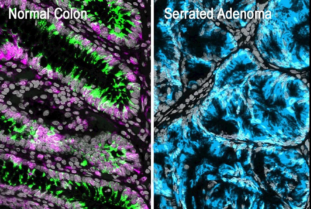 Researchers identify the initial steps in colorectal cancer formation