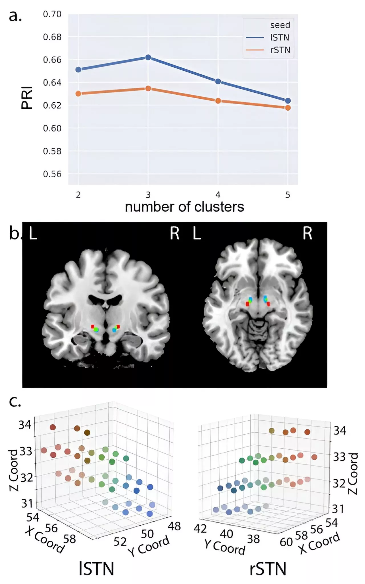 Study reveals brain mechanisms behind speech impairment in Parkinson's